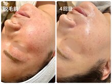 シシエル(CHICIEL)/顔脱毛で赤みも軽減されて白く♪