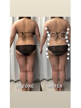 レチカ(Rechica)/吸い上げ（吸引）＋深部ラジオ波