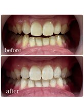 ホワイトニングカフェ 吉祥寺店(WhiteningCafe)/12回コース / ビフォーアフター