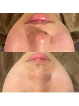 ローズマリー(rosemary)/【本格肌荒れケア】