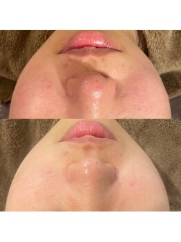 ローズマリー(rosemary)/【本格肌荒れケア】