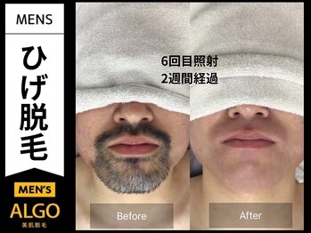 アルゴ 山口宇部店(ALGO)/頑固な髭も6回でこの仕上がり！