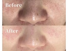 ルポ 鶴見(Repos)/黒ずみ毛穴/角栓除去★毛穴洗浄