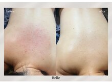 ベル 新橋(Belle)の雰囲気（【繰り返すニキビ】集中肌荒れコース|アクネ菌退治）
