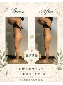 リンガ(Ringa)/施術前後で変わる横姿
