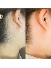 ワックスラボ(WAXLAB)/うなじWAX＋うなじ光脱毛