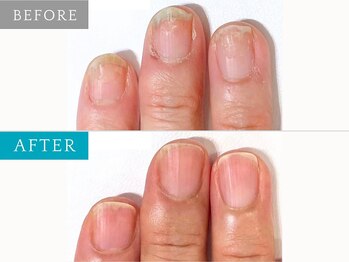 ジェルでボロボロの状態から改善