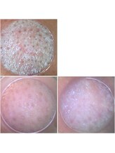 ピュア 川越店/毛穴プレミアムコース