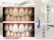 シアホワイト(CIA WHITE)/劇的ビフォーアフター