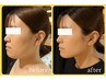 【9月平日限定】大人気★小顔専門店の脂肪分解レモンボトル 2cc ×2回