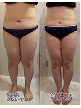 クールスパ(COOL SPA)/40代女性 脚症例