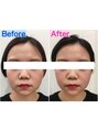 エムスラッシュアヴェダ 自由が丘(M.SLASH AVEDA)&nbsp;ミオヘッド１回の結果♪（個人差あります）