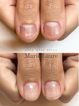 マリーロール 梅田店(Marie Laure)/深爪矯正/自爪育成/自爪風