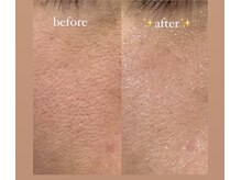 リエイト(Re:eight)/プラズマ＋ハイドラ