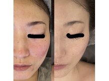 オリエンタルビューティー(ORIENTAL BEAUTY)/プラズマフェイシャル