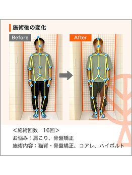 ただき接骨院 整体院 高関院/お悩み：肩こり・骨盤の歪み