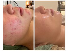 美しぐれ 溝の口店/【1年】プラズマ/延髄導入/MTS