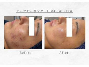 エヴァーグレース 三河安城店(EVER GRACE)/【肌管理】ハーブピーリング+LDM