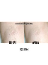 ファウラ(faura:)/ワキ脱毛