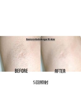 ファウラ(faura:)/ワキ脱毛