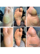 長岡巻き爪矯正センター/フットケアビフォーアフター