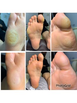 長岡巻き爪矯正センター/フットケアビフォーアフター