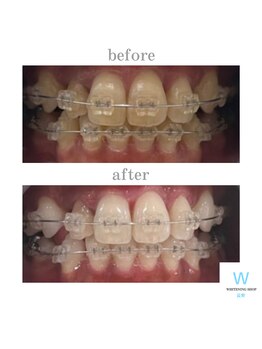 ホワイトニングショップ 長野店/アタッチメント付きでもOK！