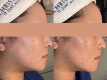 ロイ 初生店(LOI)/60分で小顔に！！小顔リフト