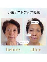 ラ コンシェル 代々木上原店/リフトアップ美鍼、お客様の結果