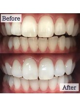 LBSホワイトニング 錦糸町店/ホワイトニングビフォーアフター