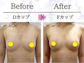 メディカルサロン エム エム エム 大阪梅田グランドサロン(M.M.M)/【バストアップ例】　D→Fカップ