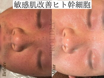 プラウディア(PROUDIA)/ヒト幹細胞×ハーブピーリング