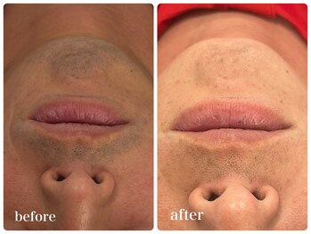 エリクサー 加須店(Elixir)/6回の照射で薄くなります!◎