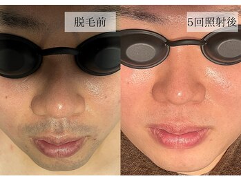 メンズアルファ/【髭】光脱毛before after 30代