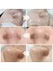 ベルナブリエ(BERNA BRILLER)の写真/【韓国肌管理】最新毛穴特化マシン導入◎ 水素毛穴洗浄×美容導入で憧れのノーファンデ水光肌へ
