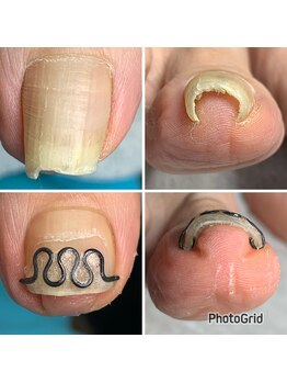 長岡巻き爪矯正センター/巻き爪ビフォーアフター