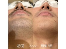 ダリオムズ 西宮北口(DAHLI HOMMES)/☆メンズヒゲ脱毛☆照射7回目