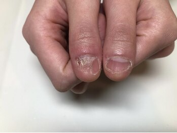 エルナ(elna)の写真/【深爪矯正に特化したメニューで、長年深爪でお悩みだった方も憧れの美爪に！】