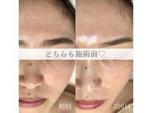 エクレ(eclat)/最短・最速でお肌が変わる