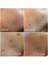 ヴィアージュ(Viage)/シミケア