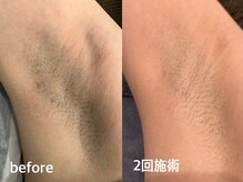 ヴィセラ(Vicella)/20代女性脇脱毛