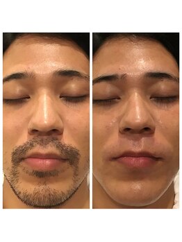 メンズ エステティック ヒーロー(men's esthetic HERO)/ヒゲWAX