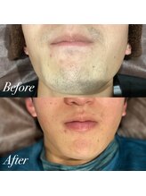 ボス 大曽根店(BOSS)/カミソリ負け＆ヒゲ剃り卒業！