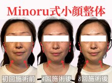 フレキシボディ(FlexiBody)/小顔施術ビフォーアフター #6