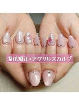 マニエネイル(mani e nail)/春夏に向けて深爪矯正スタート！