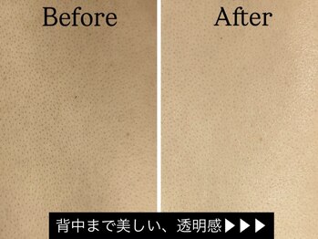 ビューティービレッジ(Beauty village)/背中脱毛でここまでキレイに！