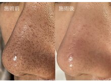 ルポ 鶴見(Repos)/しぶとい角栓もお任せを★