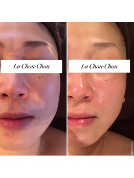 ラシュシュ(La Chou Chou)の写真/フェイスラインのたるみやもたつきに◎RFラジオ波でキュッと小顔♪すっきりフェイスライン＆ハリ艶肌へ