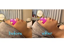 プライム(Prime)/ハーブピーリング