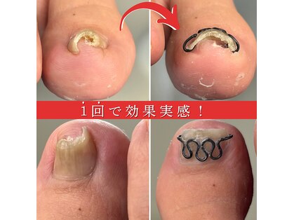 巻き爪矯正センター 沖縄 宜野湾の写真
